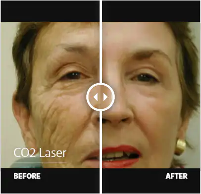 CO2 laser before and after