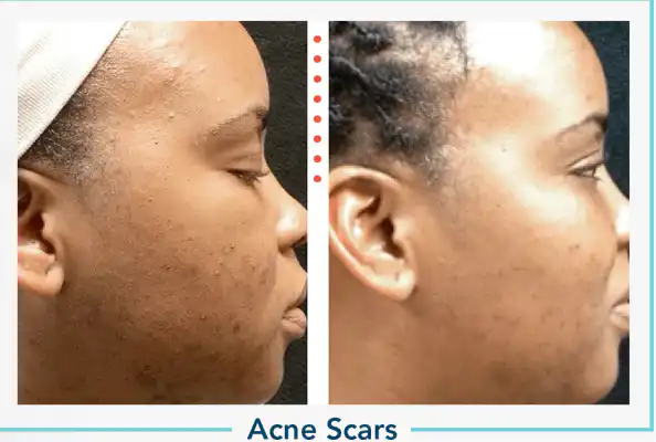 acne scars