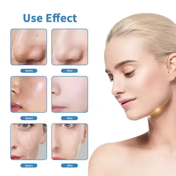 1 professional hydrodermabrasion machine where to buy a
