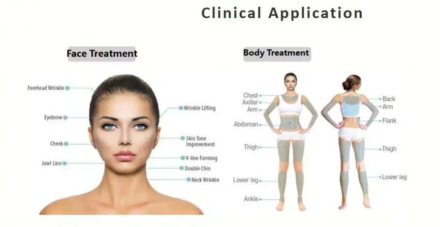 7D HIFU body treatment pass showing depth and energy settings
