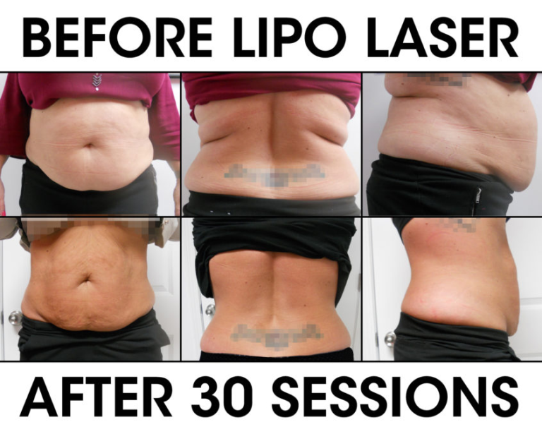 liposuction