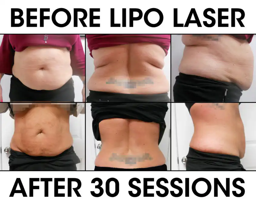 liposuction