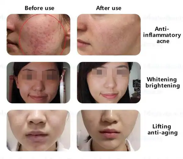 cold plasma pen skin rejuvenation