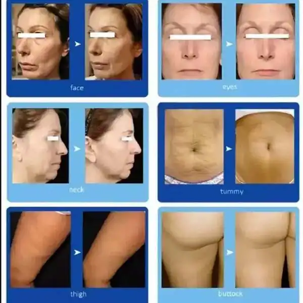 skin tightening fat reduction skin tightening